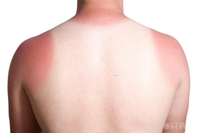 250822-2끝나지 않는 더위, 햇빛 화상 대응법.jpg