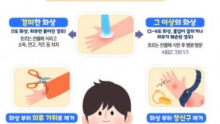 성산소방서, 화상 사고 발생 시 응급처치  이렇게 하세요!